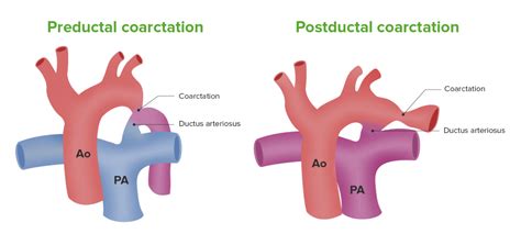 Coarctation Of The Aorta And Pda