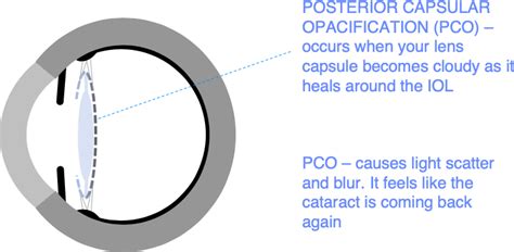 YAG laser capsulotomy