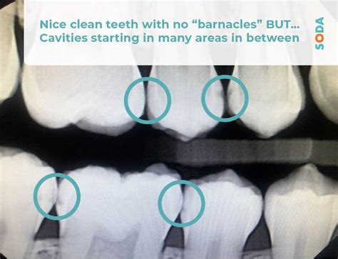 Learn To Read your OWN Dental Xrays! — SODA