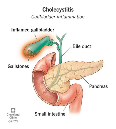 Cholecystitis (Gallbladder Inflammation): Symptoms & Treatment