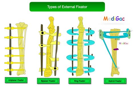 External fixation – Indications, Types, Working principle ...