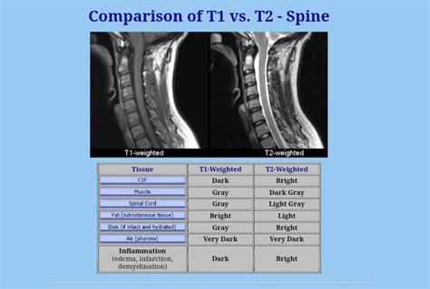 Mri T1 T2 Difference