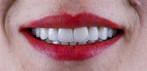 Pros and Cons of Getting Porcelain Veneers on Your Teeth