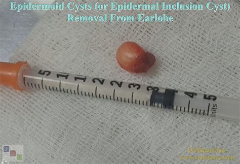 Removal of Earlobe Cyst