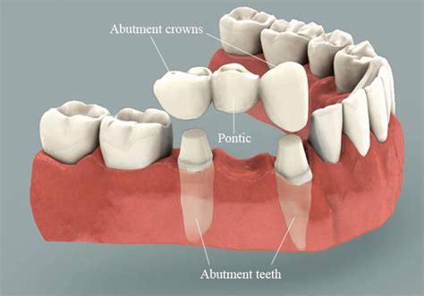 Bridges | Old Hook Dental