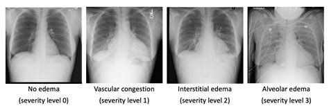 Pulmonary Edema Chest X Ray