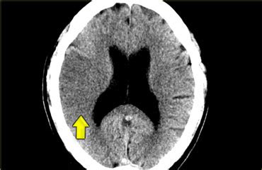 The Radiology Assistant : Imaging in Acute Stroke