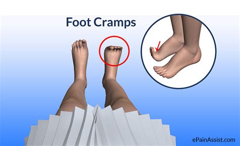 Foot Cramps: Treatment, Causes, Ways To Get Rid of Cramps, Symptoms