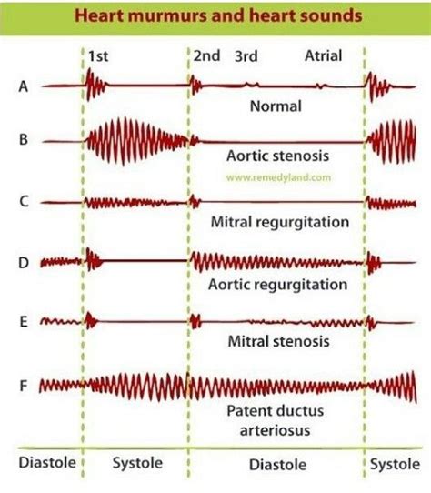 Heart murmurs and heart sounds Nursing Schools In Nyc, Nursing School ...