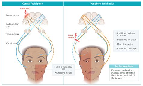 Facial Nerve Palsy Upper Motor Neuron