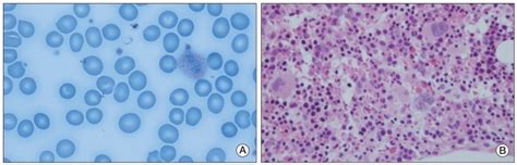 (A) Peripheral blood smear revealed macrocytic normochromic anemia (H&E ...