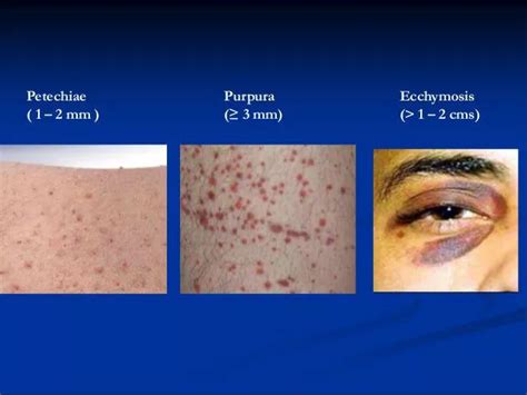 MEDizzy - Petechiae vs Ecchymosis vs Purpura | Pathology, Hematology ...