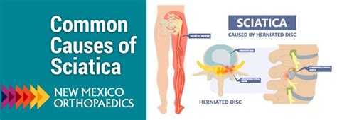 Common Causes of Sciatica - New Mexico Orthopaedic Associates