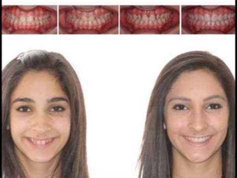 Lingual Braces Before and After - YouTube