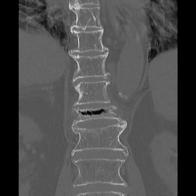 Radiology Cases: Chance Fracture II - Subsequent CT