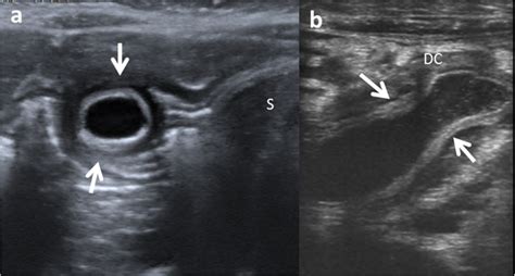 Enteric duplication cysts in children: varied presentations, varied ...