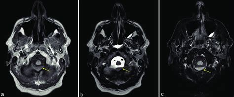 Axial MRI of the foramen magnum showing dependent blood products. (a ...