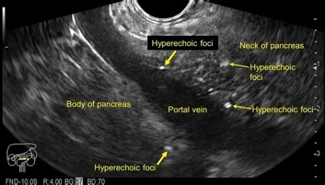 Chronic Pancreatitis Ultrasound