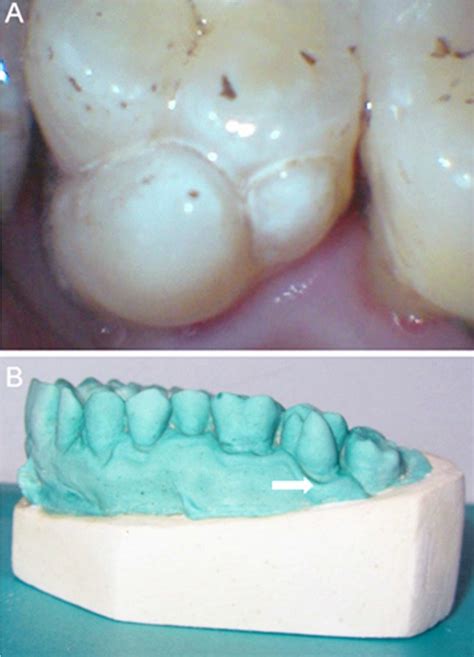 (A) Clinical image showing paramolar tubercles on the buccal surface of ...