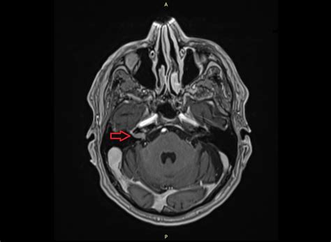 Cureus | A Suspected Vestibular Schwannoma with Uncharacteristic Growth ...