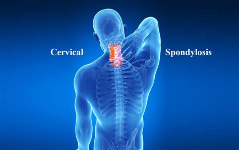 Cervical Spondylosis : Symtoms, Causes and Remedies - InfoDrishti