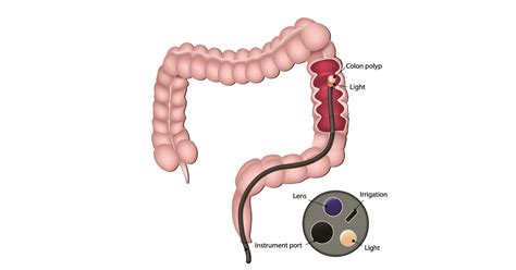 Sigmoidoscopy: Purpose, Preparation, Procedure & Aftercare