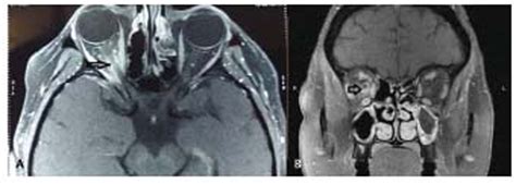 Optic Perineuritis in a Case of Tolosa–Hunt Syndrome - Journal of ...