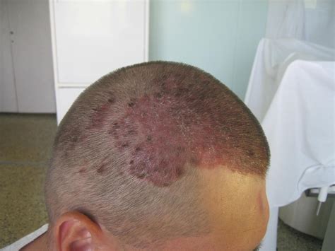 Photos of scalp psoriasis | Symptoms and pictures