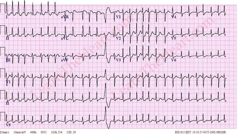 Các bất thường trên ECG: