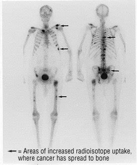 Bone Scan Guide