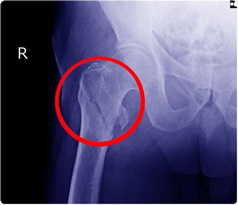 Hip Fracture Xray