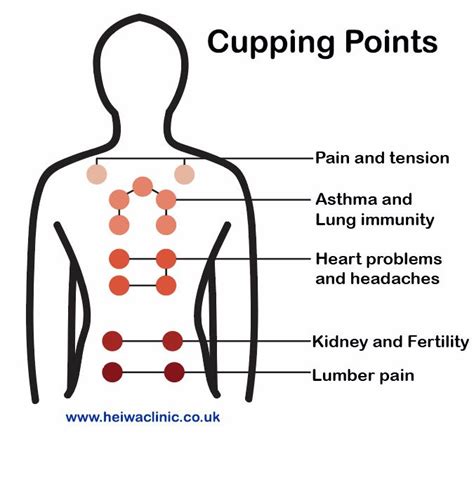 Cupping Therapy for better health