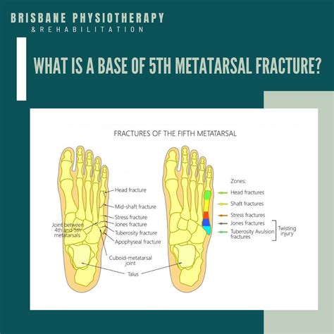 Head Of Metatarsals