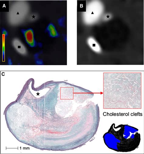 Representative images of cholesterol crystals (CCs) using cholesterol ...