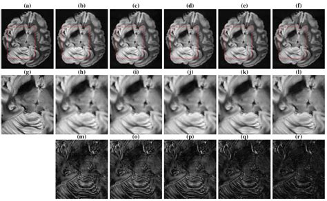 Compressed Sensing MR image reconstruction – Parietal