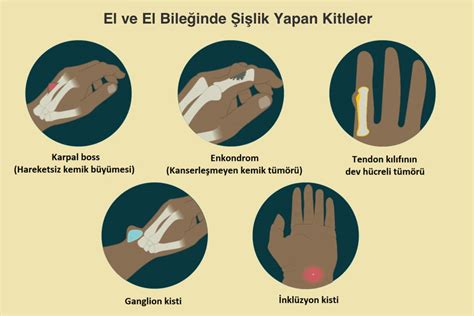 El Bileğinde Şişlik - El Bileğinde Şişlik Yapan Hastalıklar Nelerdir ...