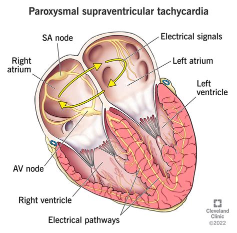 Paroxysmal Supraventricular Tachycardia (PSVT): Causes & Symptoms