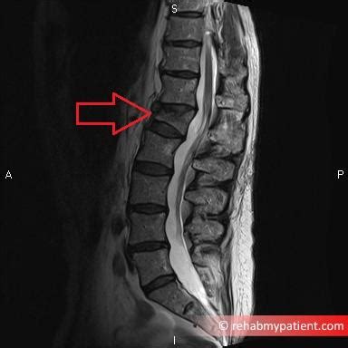 Anterior Wedging Of Vertebral Bodies - tiktoktoktok