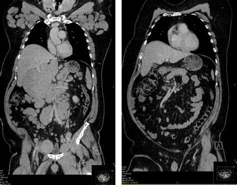 Pet Scan Images Of Lymphoma