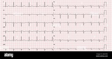 12 Lead Ekg Sinus Rhythm