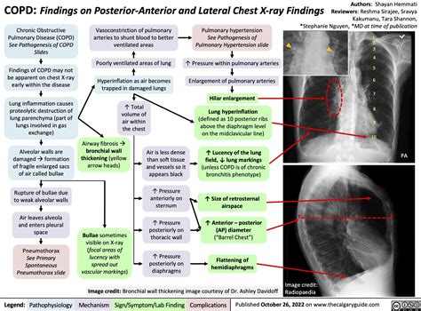 copd-findings-on-posterior-anterior-and-lateral-chest-x-ray-findings ...