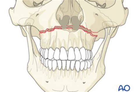 A Dental Student's Guide to...Le Fort fractures - Dentistry