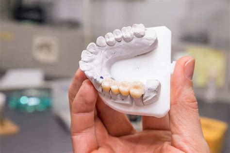 What to Expect During the Dental Bridge Procedure