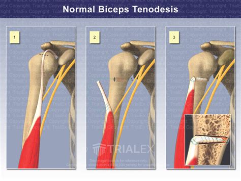 Normal Biceps Tenodesis - TrialQuest Inc.