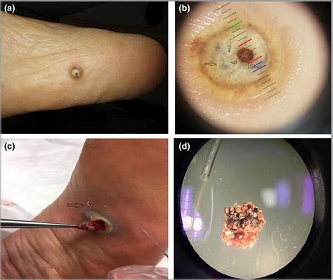 Image Gallery: Tungiasis in four steps - El Habnouni - 2019 - British ...