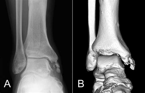 Medial Malleolus Ankle Fracture : The Radiology Assistant Ankle ...