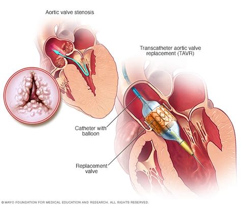 Aortic valve repair and aortic valve replacement - Mayo Clinic