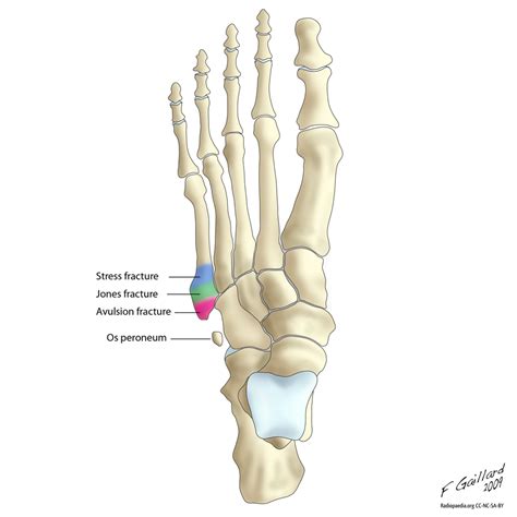 Fractures of the proximal 5th metatarsal | Radiology Case | Radiopaedia ...