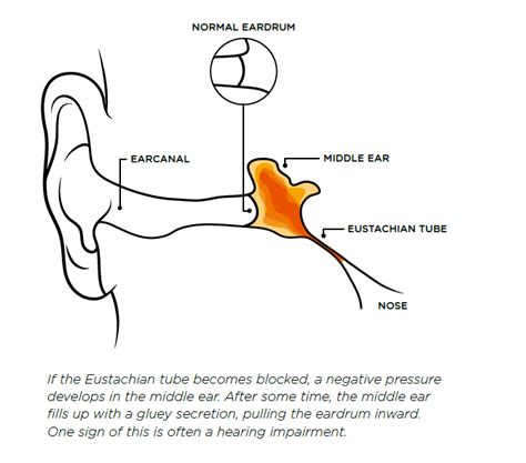 Everything You Need To Know About Glue Ear - Infographic - Otovent