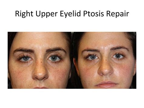 Is Ptosis Surgery Covered by Insurance? Find Out Now! - Live Free Insurance